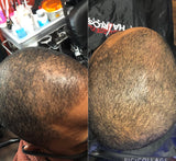 Hairloss. Oil for Men