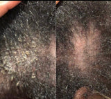 Psoriasis,Folliculitis, Dandruff care