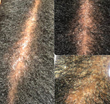 Psoriasis,Folliculitis, Dandruff care