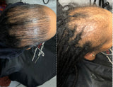 Hairloss/Alopecia Complete Bundle shampoo + Treatment + Leave-in + Extreme 22 Serum