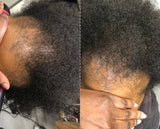 Hairloss/Alopecia Complete Bundle shampoo + Treatment + Leave-in + Extreme 22 Serum