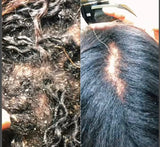 Psoriasis,Folliculitis, Dandruff care